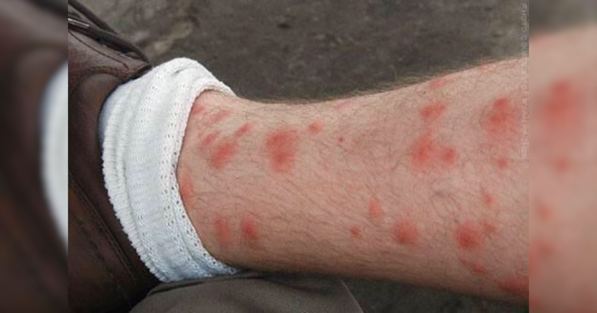 OUTSIDE Avoiding chigger trouble Harlan Enterprise Harlan Enterprise